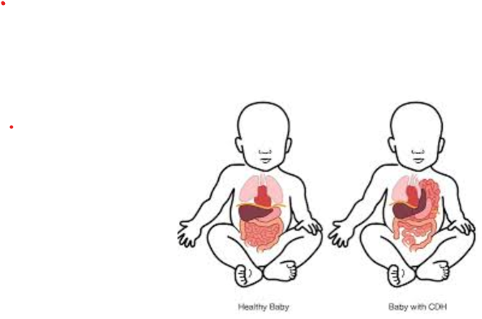 Συγγενής διαφραγματοκήλη